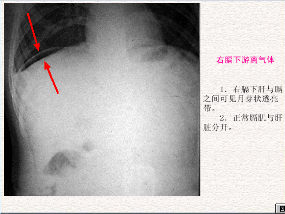 常见急腹症的x线表现ppt培训课件_第4页