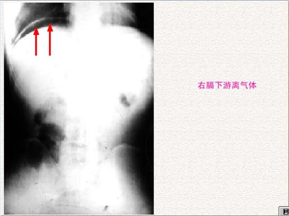 常见急腹症的x线表现ppt培训课件_第5页