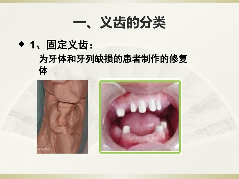 义齿的基本知识ppt课件_第3页