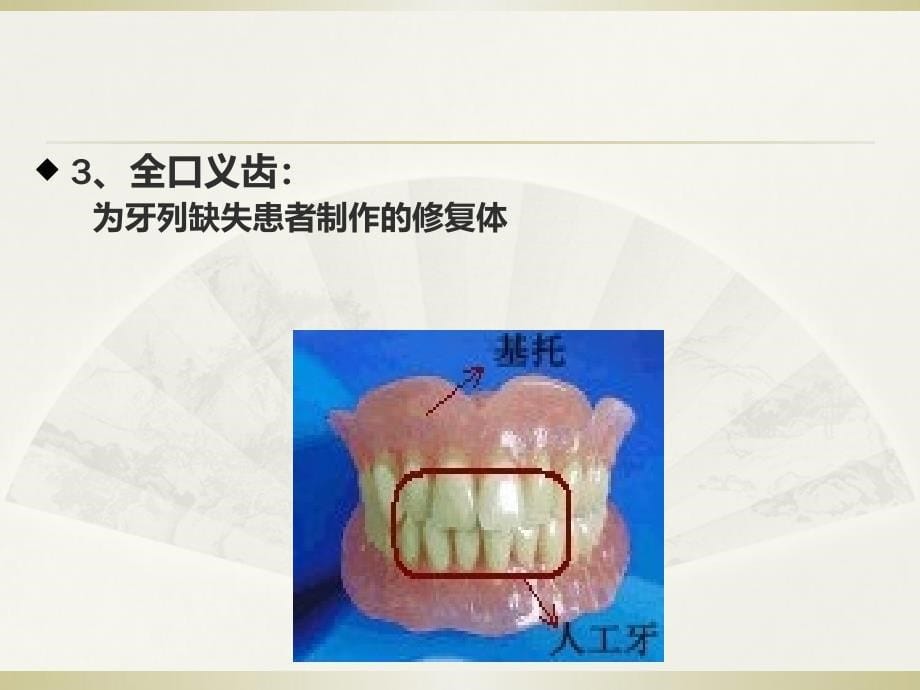 义齿的基本知识ppt课件_第5页