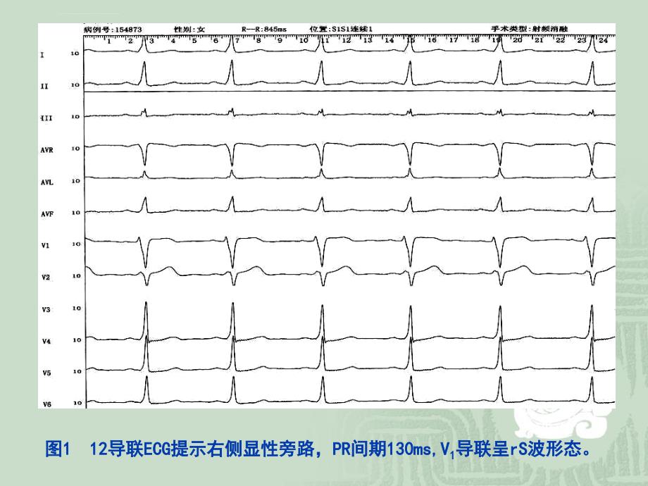 特殊旁路的表现ppt培训课件_第4页