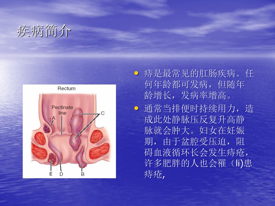 痔疮出血的观察及处理医学ppt培训课件_第3页