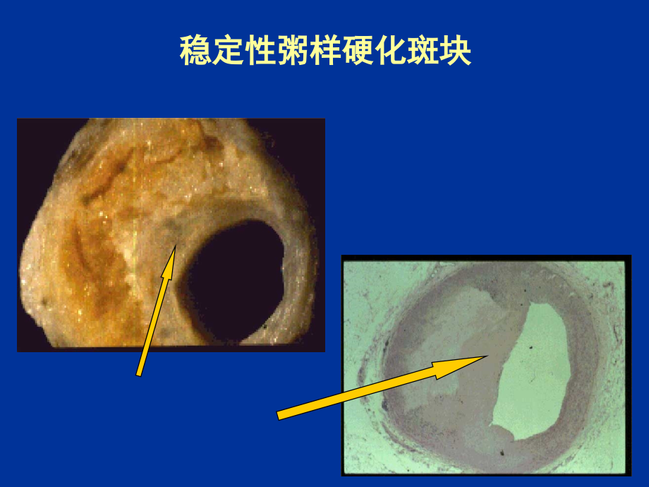 b阻滞剂与冠心病治疗1 p51_第4页