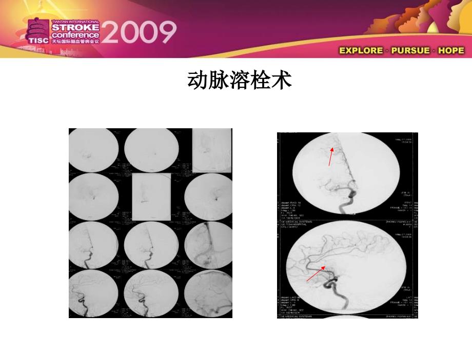 脑血管病围手术期中医药切入点的思考黄燕ppt培训课件_第4页