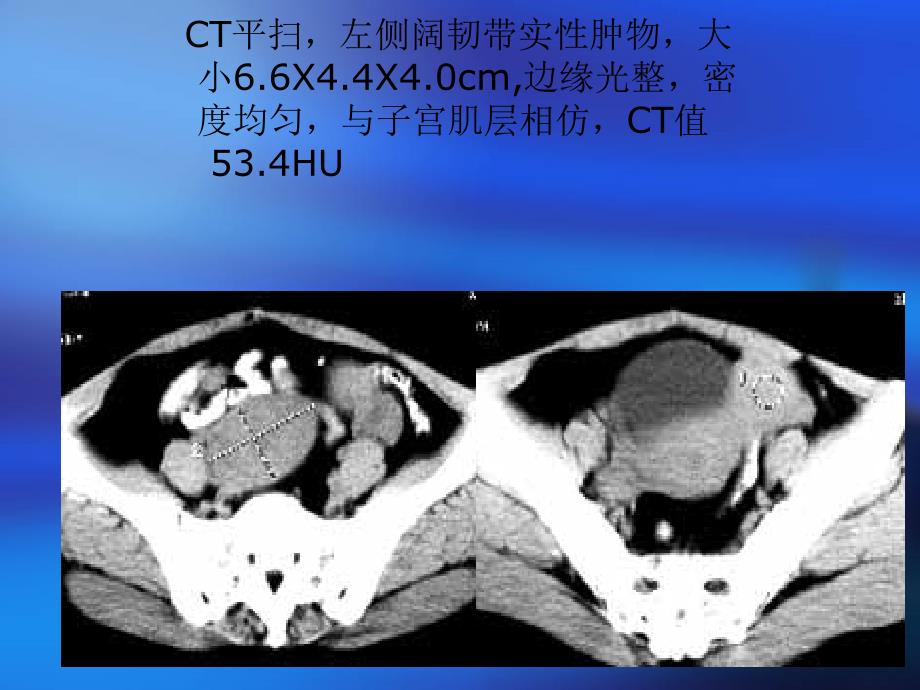 ct在女性生殖系统的应用 经典_第3页