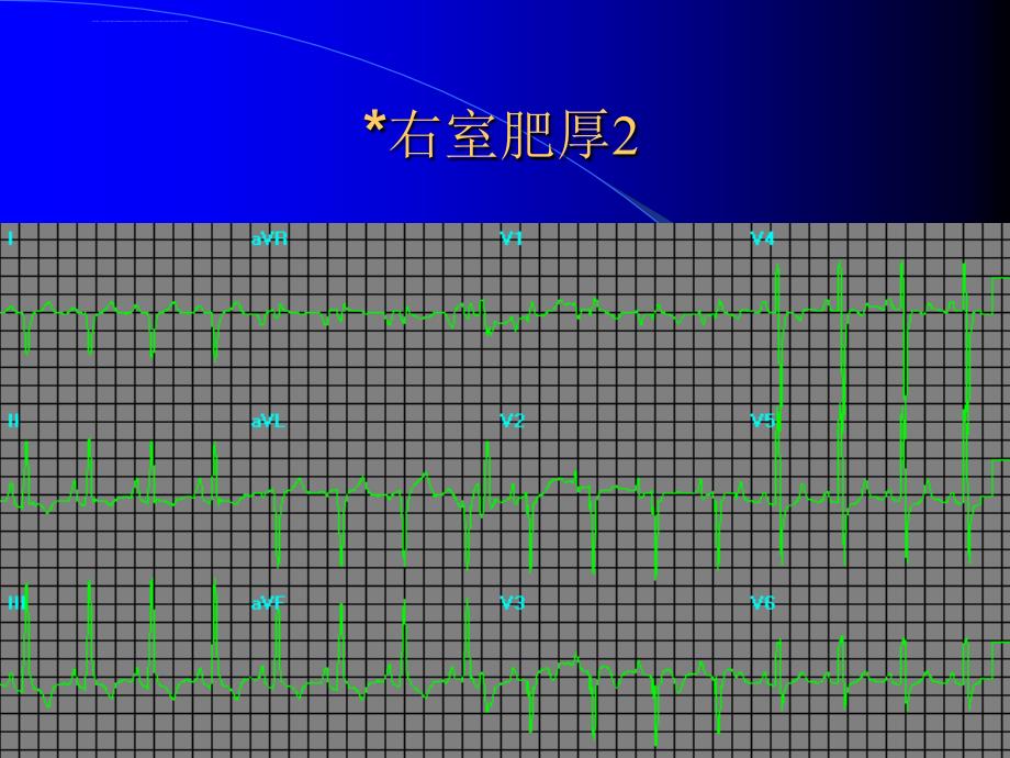 心电图课件_第4页