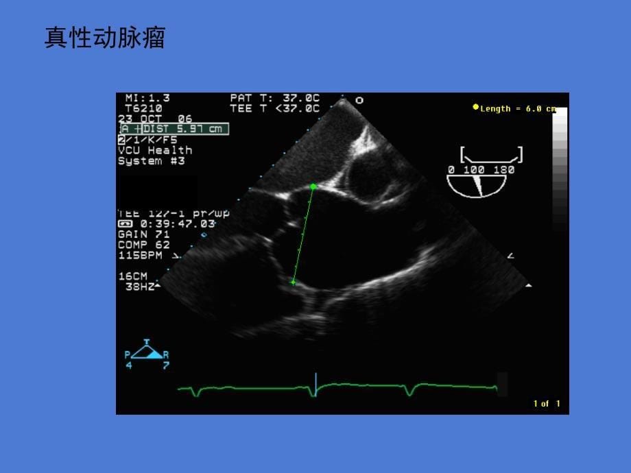 大血管疾病的超声诊断课件_第5页