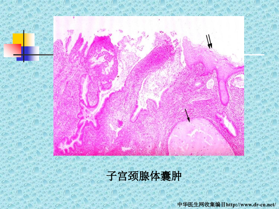 慢性子宫颈炎和宫颈癌-妇产科教研室-张秀芬ppt培训课件_第3页