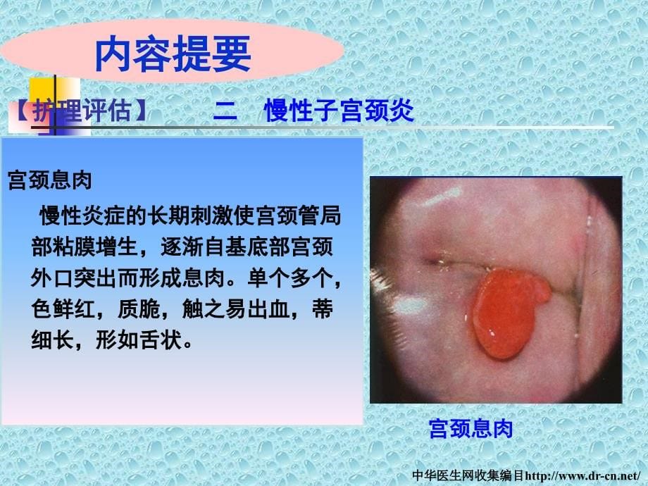 慢性子宫颈炎和宫颈癌-妇产科教研室-张秀芬ppt培训课件_第5页