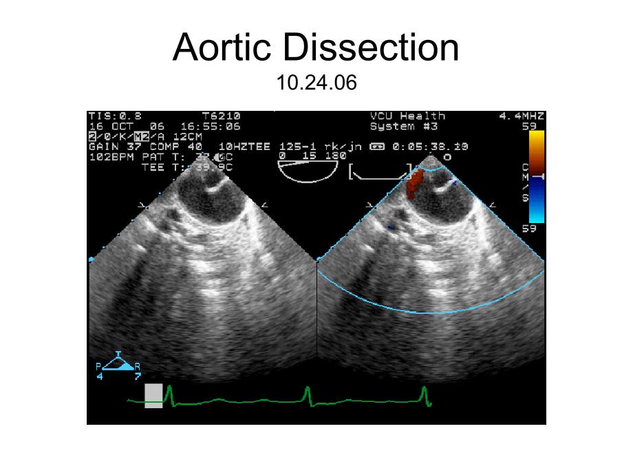 主动脉疾病超声课件_第2页