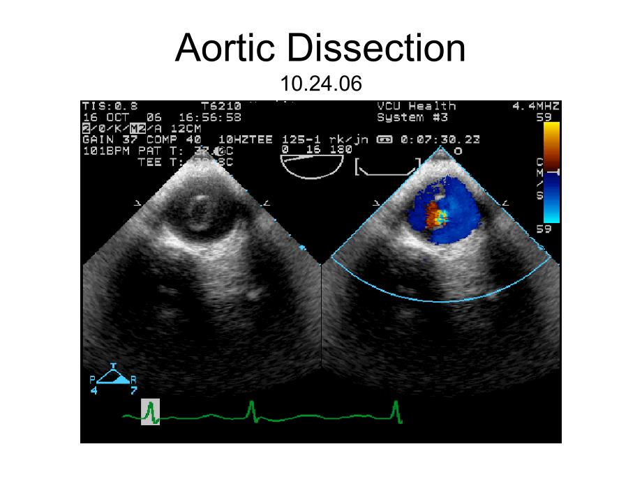 主动脉疾病超声课件_第4页