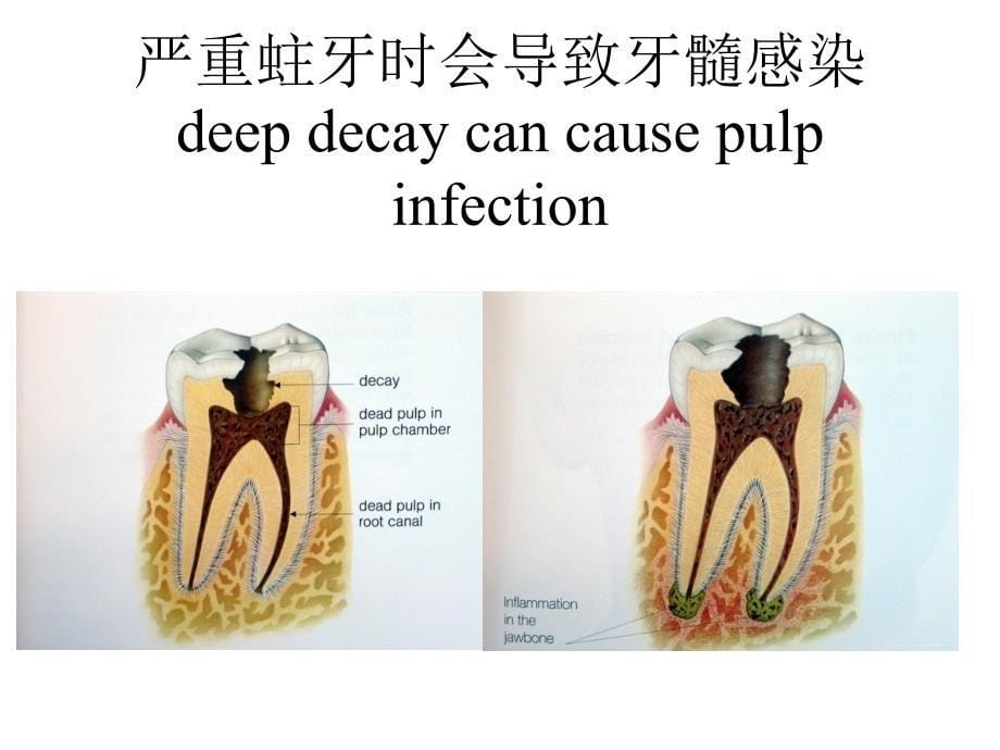 为何要做根管治疗课件_第5页