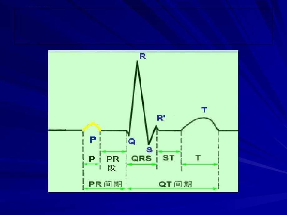 常见心电图的诊断ppt培训课件_第5页