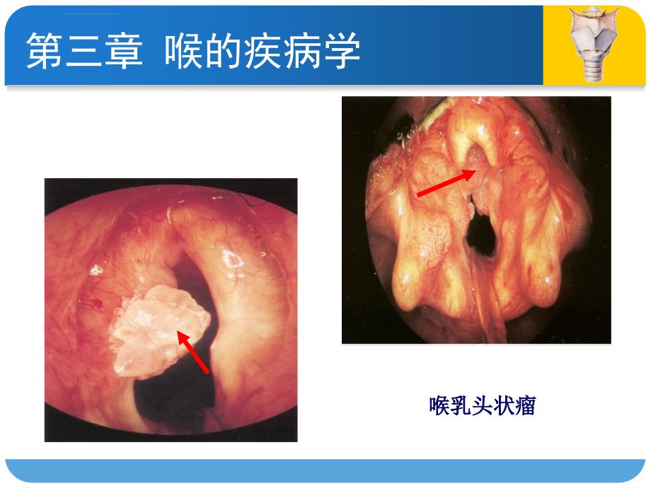 【专业课件】喉的良性病变与喉癌图谱_第3页
