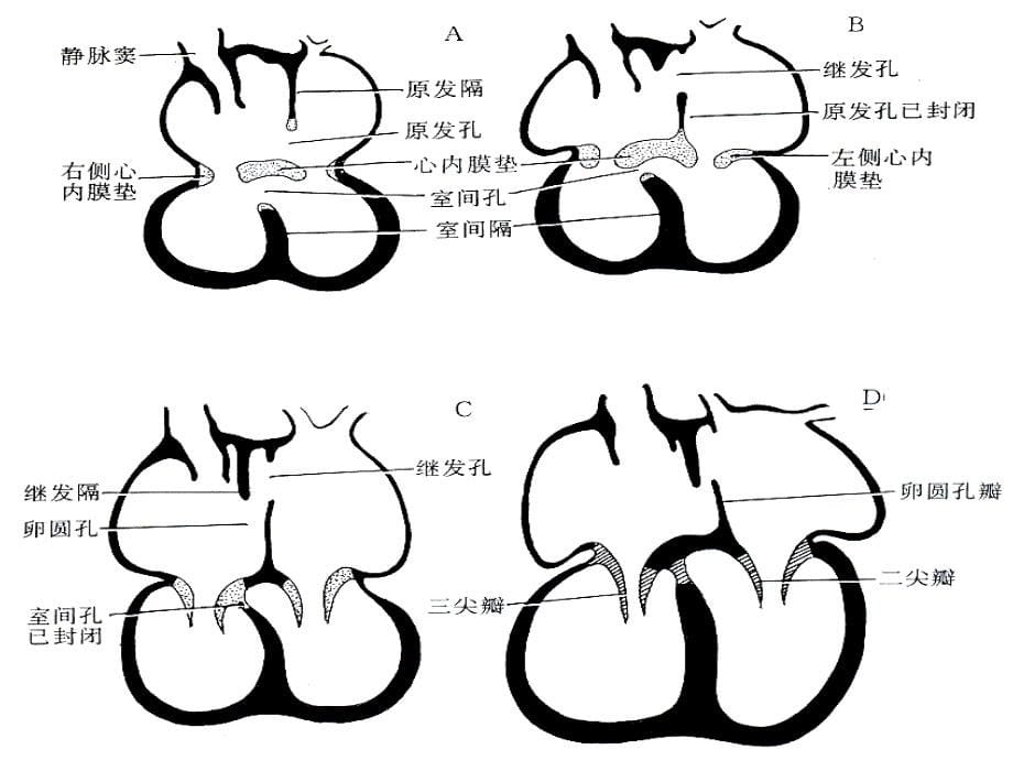 房间隔缺损ppt培训课件_第5页