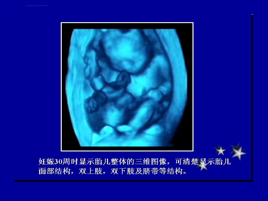 胎儿中枢神经系统异常的超声诊断课件_第4页