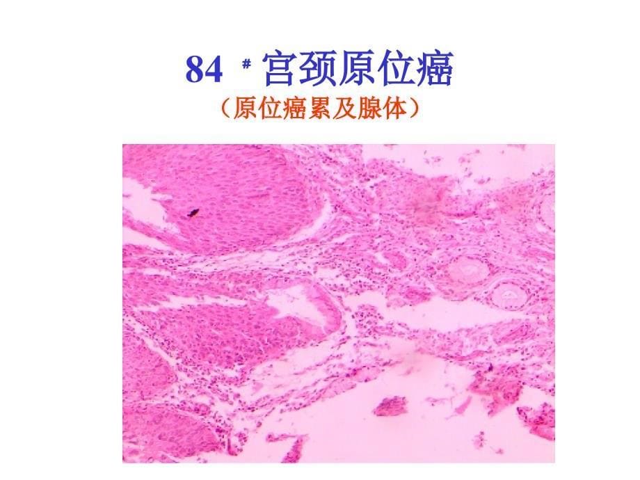 病理学1生殖系统疾病课件_第5页