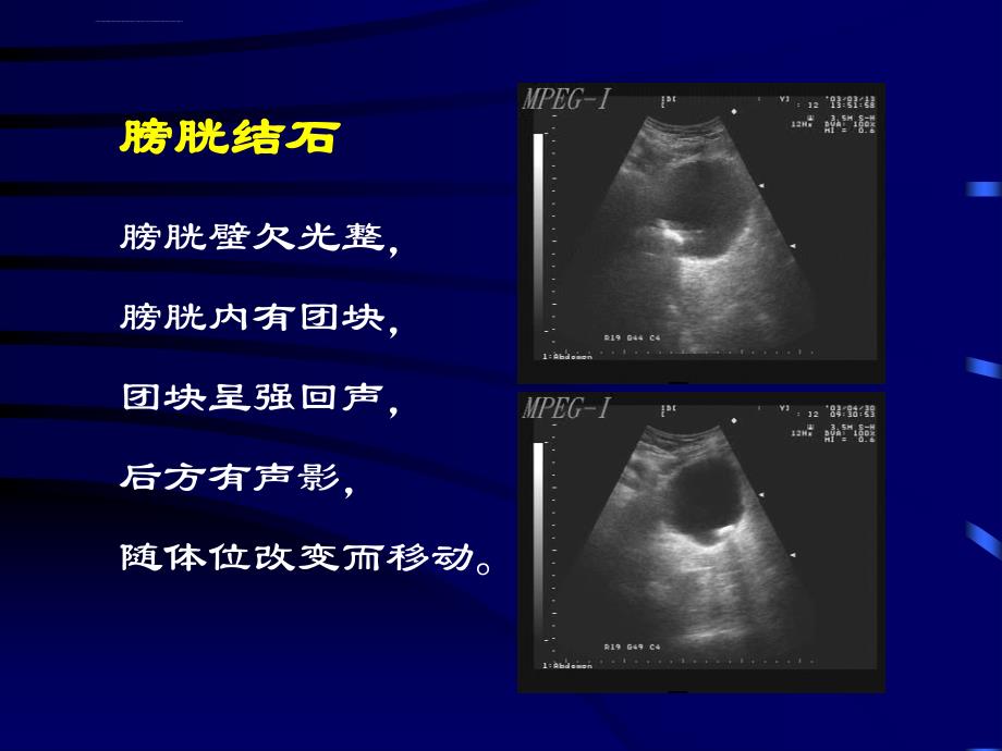 膀胱前列腺超声诊断学+ppt培训课件_第3页