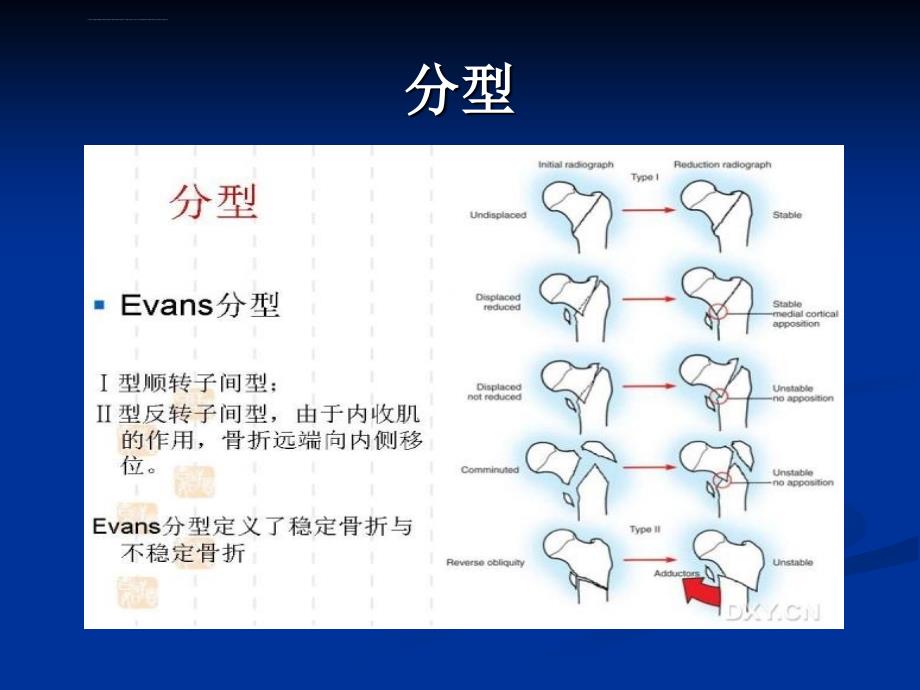 粗隆部骨折课件_第4页