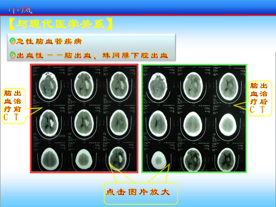 针灸治中风课件_第3页