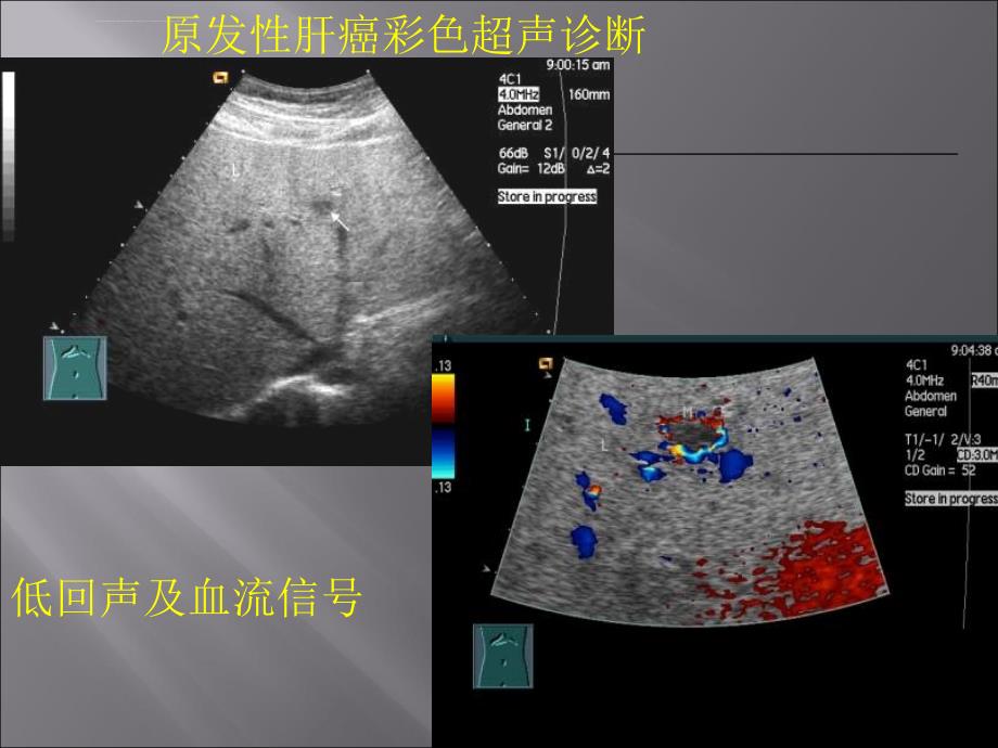 肝癌分析课件_第4页