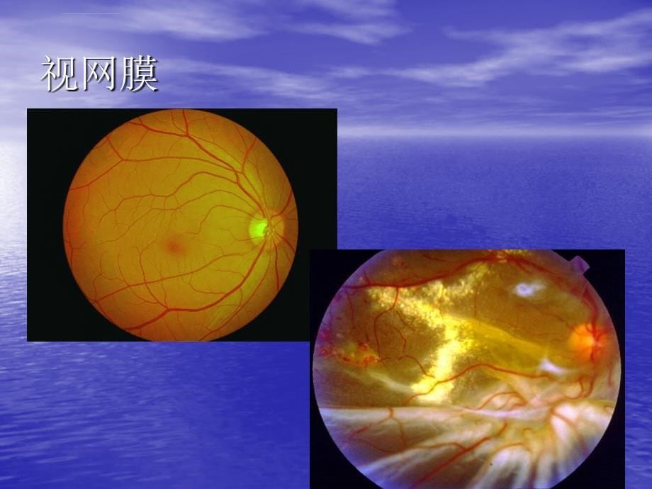 糖尿病视网膜病变课件_第5页