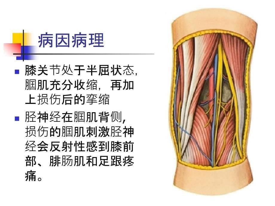 腘肌损伤教学课件_第5页