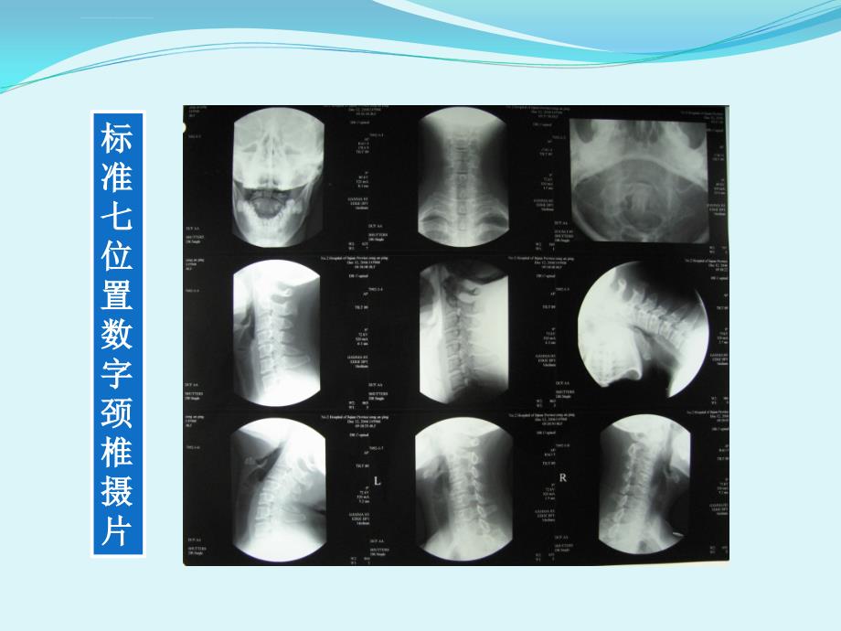 颈椎病分期综合诊疗方案课件_第4页