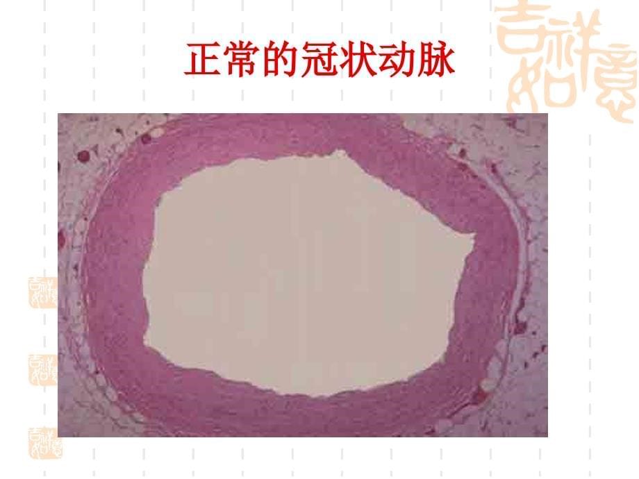 冠状动脉粥样_第5页