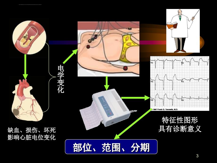 心肌梗死-6_第3页