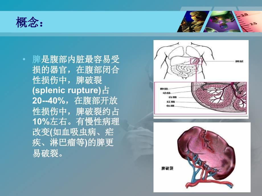 脾破裂护理查房_第3页