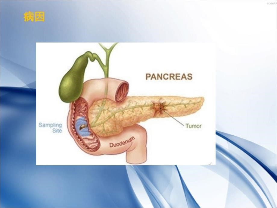 急性胰腺炎ppt_第5页