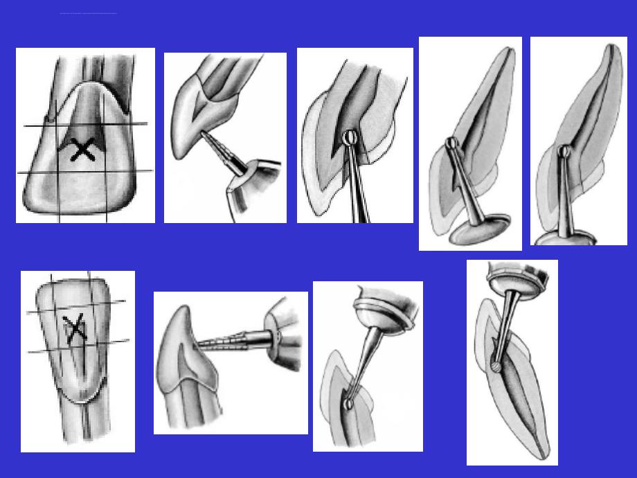 牙髓根尖周病的治疗ppt培训课件_第4页