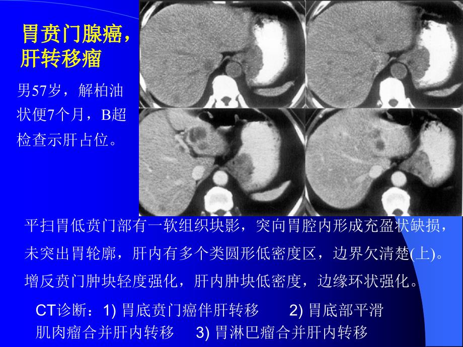 CT诊断胸腹水ppt课件_第4页