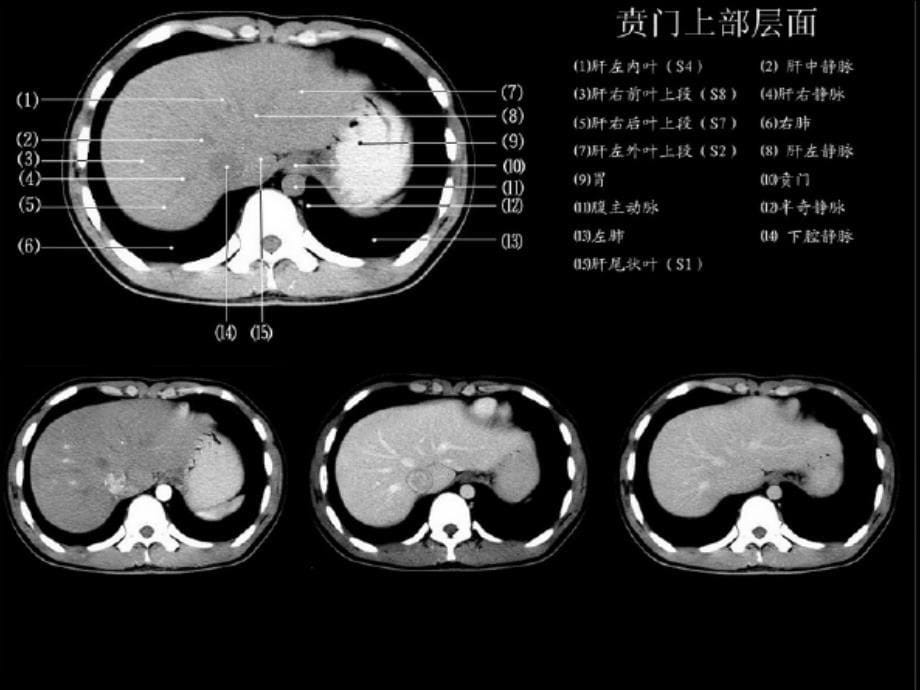 正常肝脏ct解剖课件_第5页