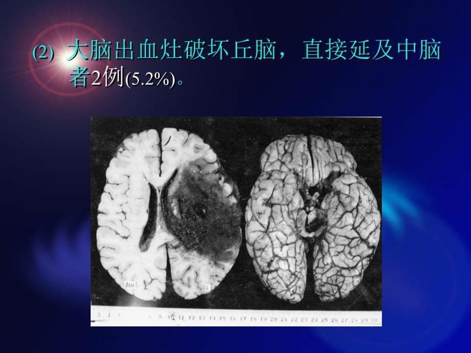 脑出血继发病理生理改变及对预后的影响_第5页