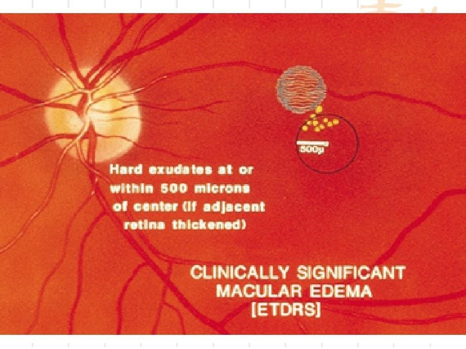 糖尿病性黄斑水肿_第5页