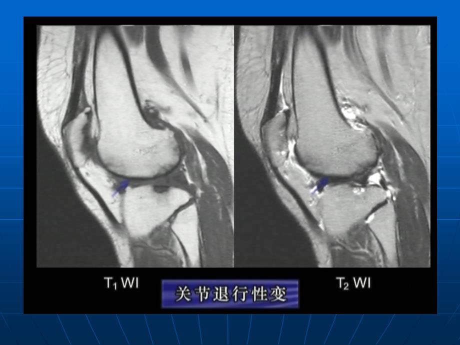 骨关节MRI读片3_第4页