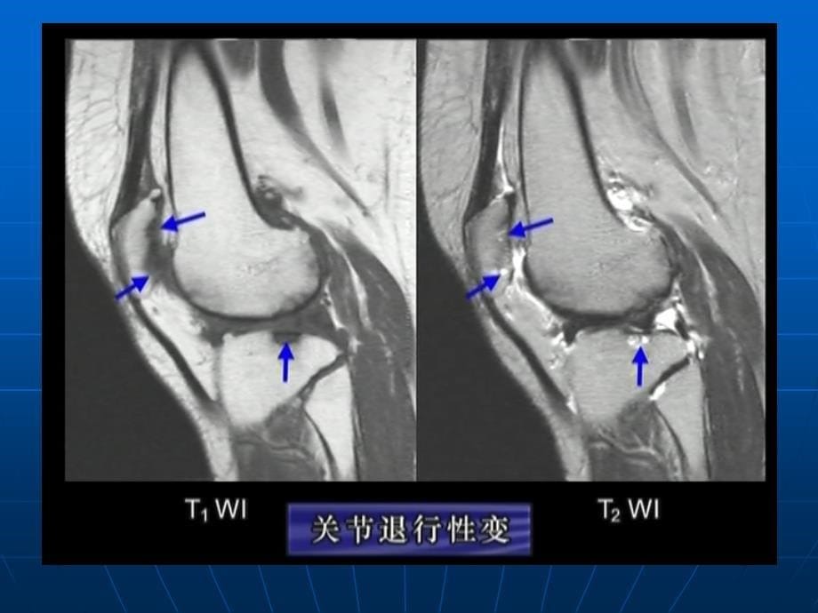 骨关节MRI读片3_第5页