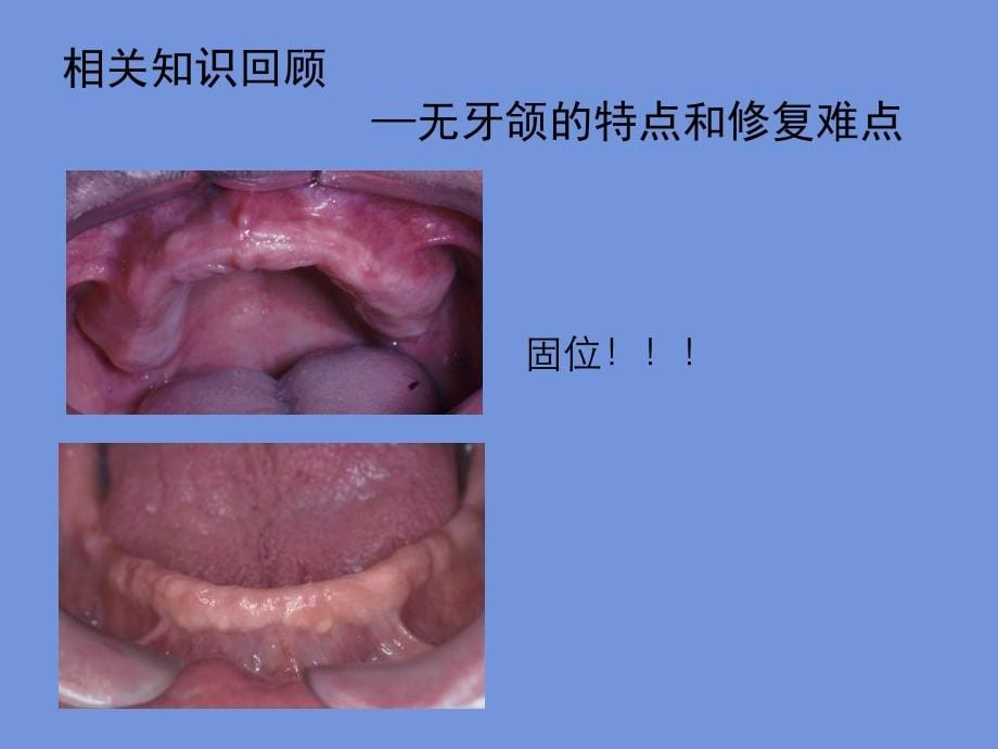 印模和模型制作（首都医科大学口腔医学院）课件_第5页