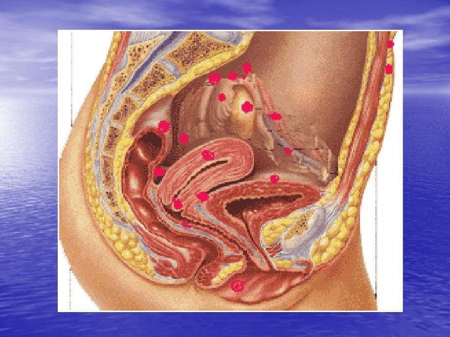 年制子宫内膜异位症课件_第5页