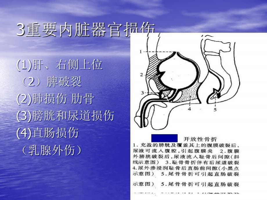 骨折的并发症_第5页