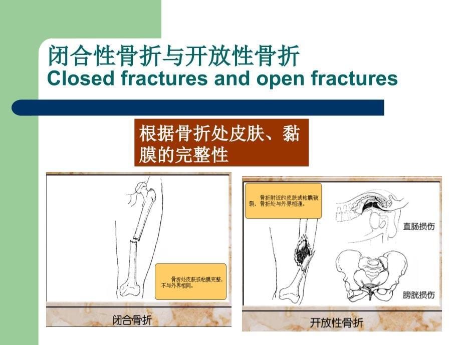 骨折康复3.0_第5页