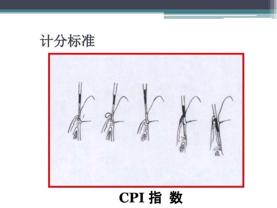 龋病的预防_第5页