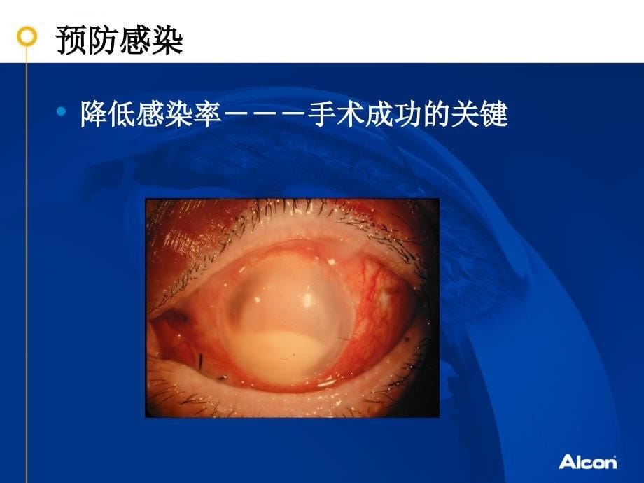 白内障手术围手术期的合理用药ppt课件_第5页