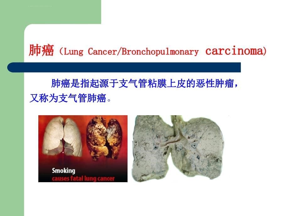 医学ppt--肺癌的早期诊断与防治_第5页