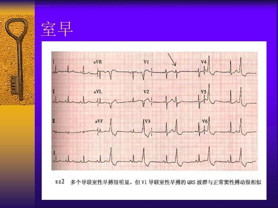 院前心电图识别ppt课件_第5页