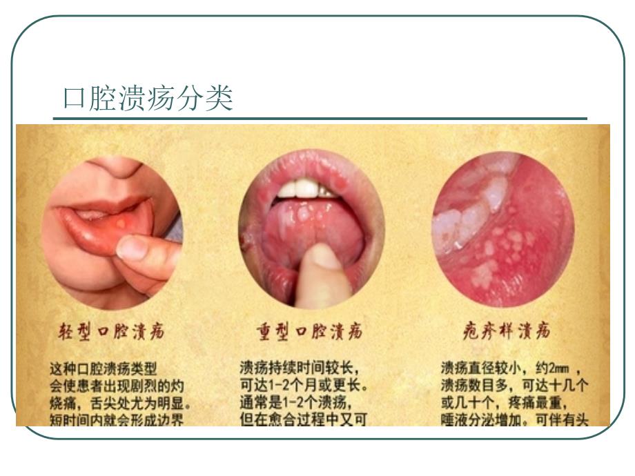 项目五模块二口腔溃疡ppt课件_第3页