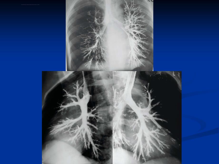 医学影像诊断学-呼吸系统3ppt课件_第3页