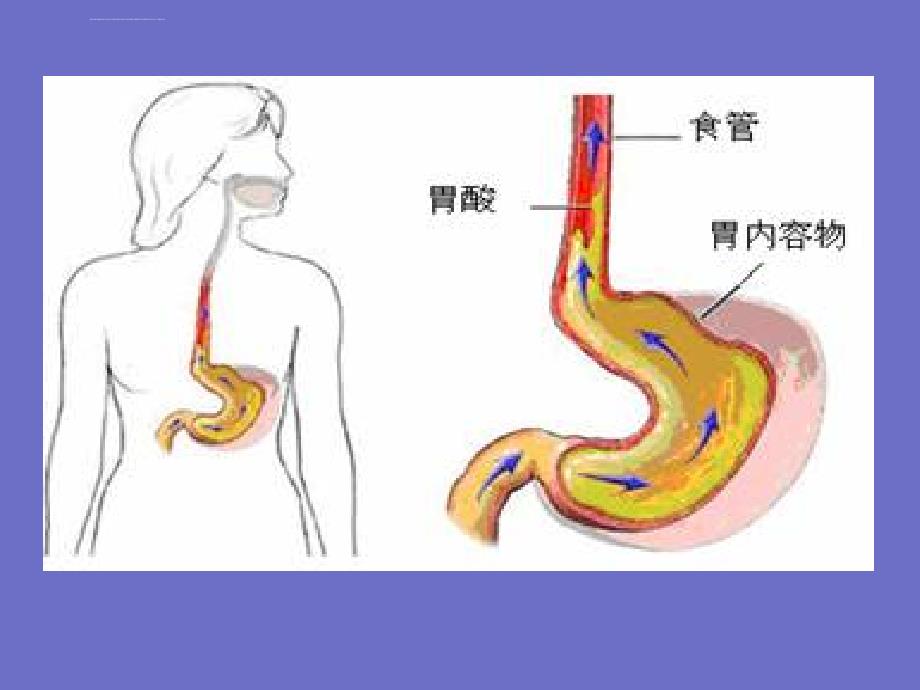 胃食管反流修改ppt课件_第4页